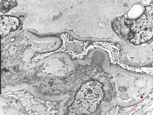 M,47y. | IgA nephropathy